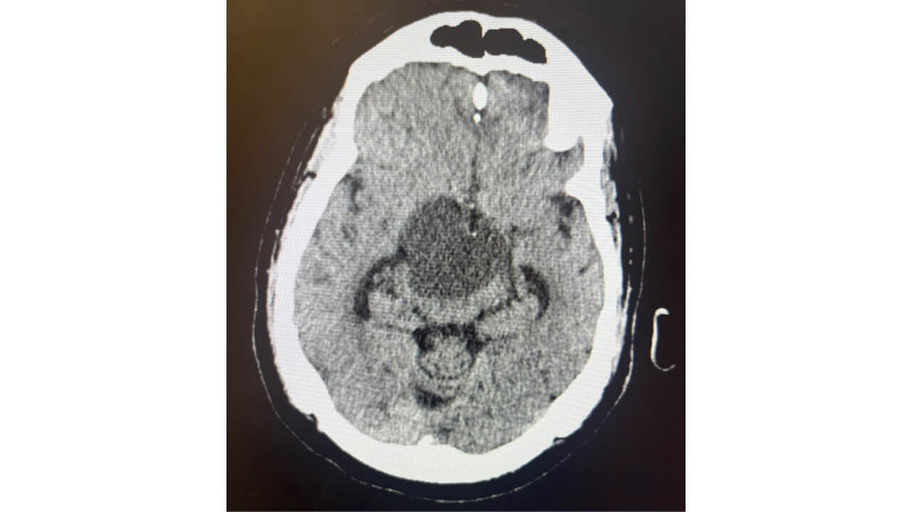 CT head w/o contrast 10/13 10pm showing a craniopharyngioma