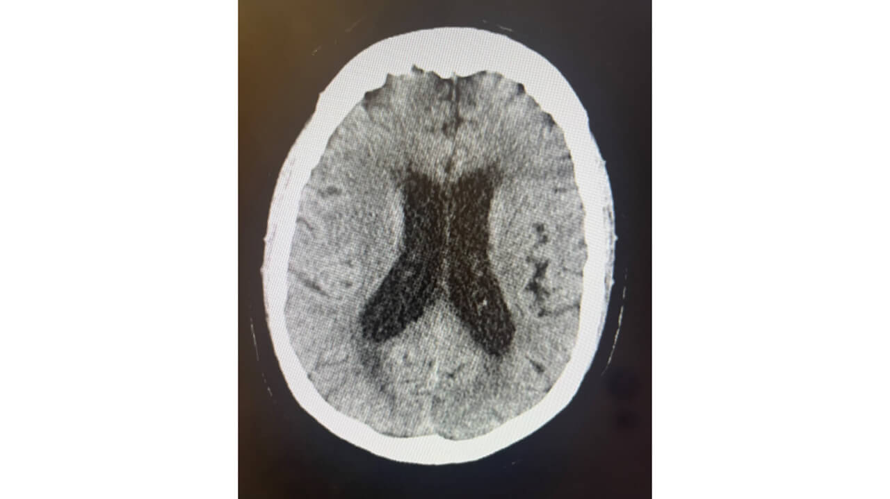 CT head w/o contrast 10/13 10pm​ showing an obstructive hydrocephalus
